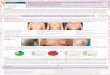Mastectomía subcutánea profiláctica: técnica, aplicaciones y … · 2018-10-14 · Mastectomía subcutánea profiláctica: técnica, aplicaciones y resultados en el Hospital Universitario