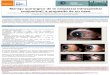 SCOFT | Societat Catalana d'Oftalmologia | SCOFTALMOLOGIA · estudio anatomopatológico, y otros mètodos diagnosticos como la tomografia de coherencia óptica de alta resolución