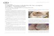 Complicaciones orbitarias de las cirugías nasales ...faso.org.ar/revistas/2011/2/1.pdf · crado al párpado y a la conjuntiva. ... por una patología in amatoria con síntomas de