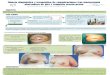 Presentación de PowerPoint - SESPM 2018...Presentar un caso de necrosis del complejo areola-pezón (CAP) y extrusión de prótesis tras una mastectomía ahorradora de piel y CAP y