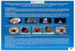 Malignización papilomas invertidos nasosinusales. HURyC · 2020. 4. 12. · preoperatoria fue de papiloma invertido con áreas de carcinoma in situ y áreas de infiltración. spin
