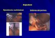 Episiotomía mediolateral. Defensa del perineo