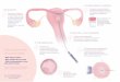 Infografia nº1 15 06 18 - Clínica de fertilidad y 